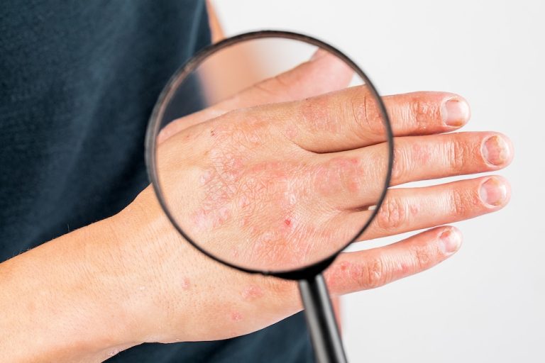 Eccema o psoriasis: guía esencial para diferenciarlas y prevenir complicaciones