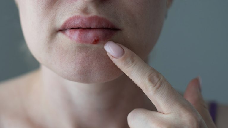 La razón por la que los labios sufren más sequedad en invierno y el consejo de los dermatólogos para tratarlo